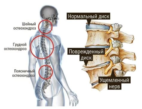 Остеохондроз и его связь с ощущением нехватки воздуха