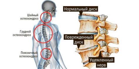 Остеохондроз позвоночника и жжение в конечностях