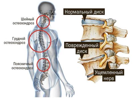 Остеохондроз поясничного отдела позвоночника: советы специалиста