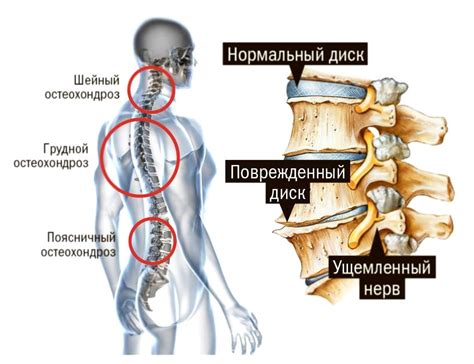 Остеохондроз спины: симптомы и лечение