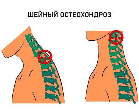 Остеохондроз шейного отдела: симптомы и диагностика