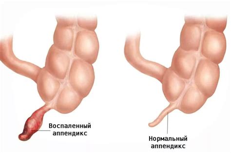 Острая аппендицит: симптомы и причины возникновения острого аппендицита