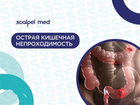 Острая кишечная непроходимость: что делать и как избежать операции