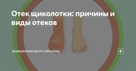 Отек щиколотки: причины и способы борьбы