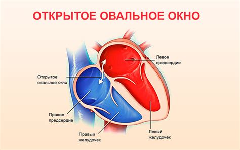 Открытое овальное окно: его смысл и значение у новорожденных