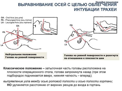 Открытые дыхательные пути во время сна