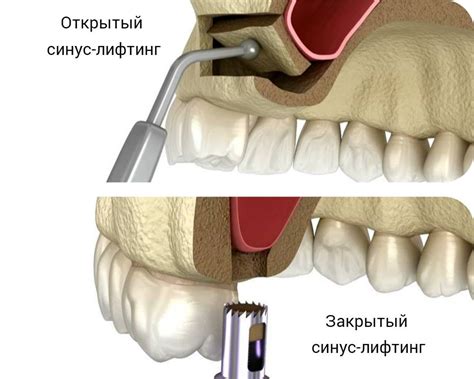 Открытый и закрытый клинч: различия и применение