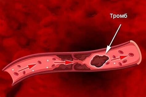 Оторвался тромб: причины и влияние на здоровье