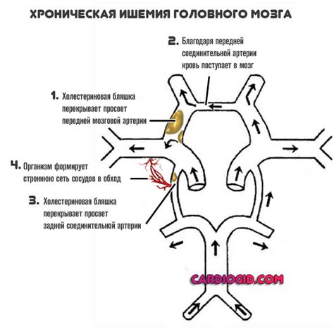 Отсутствие кровотока: виллизиев круг вариант развития