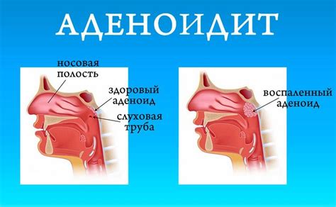 Отсутствие миндалин: причины и последствия