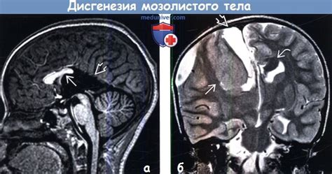 Отсутствие мозолистого тела - проблема для ребенка