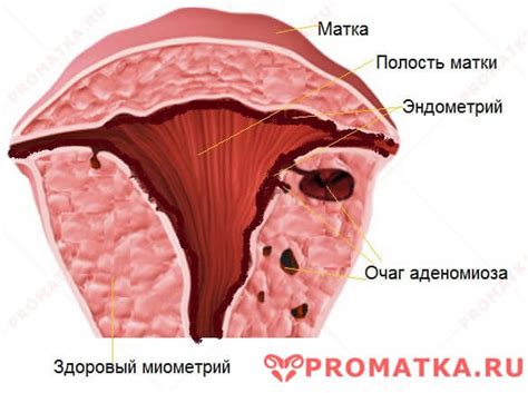 Очаги инфарцирования эндометрия: