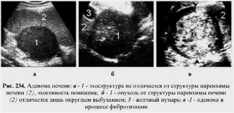 Очаговое изоэхогенное образование