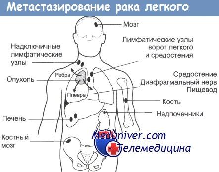 Очаговые образования: что это такое?