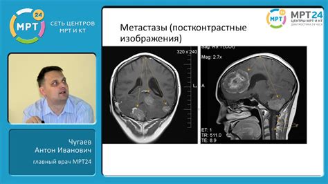 Очаг при МРТ головного мозга: суть и диагностика