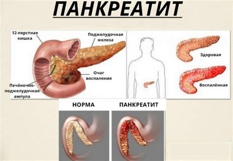 Панкреатит: симптомы и лечение