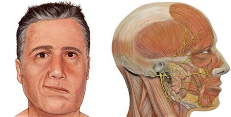 Паралич лицевого нерва