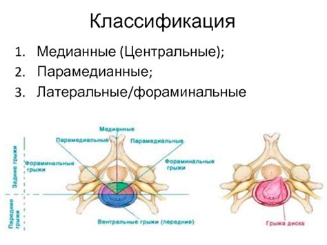 Парамедианная грыжа диска