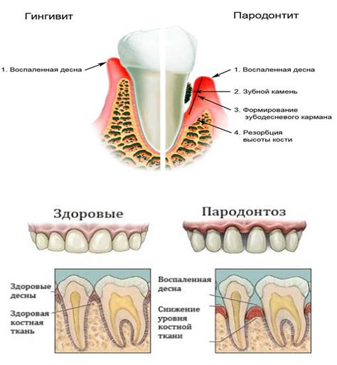 Пародонтит: запущенное состояние заболевания десен