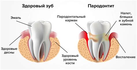 Пародонтит и его влияние