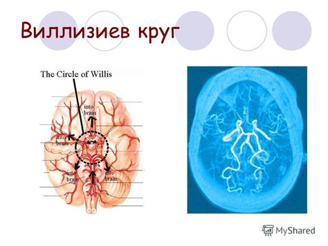 Патологии в Виллизиевом круге и их последствия