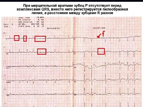 Патологическая ЭКГ у взрослого: