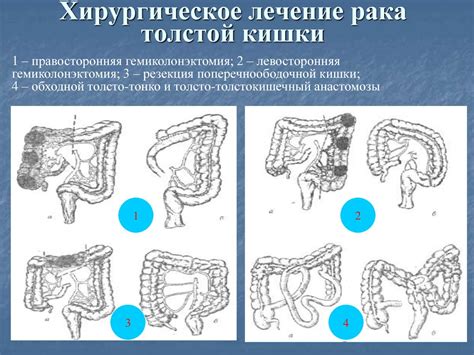 Патология ободочной кишки