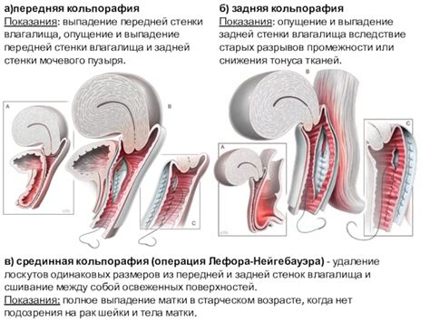 Передняя кольпорафия: определение и причины возникновения