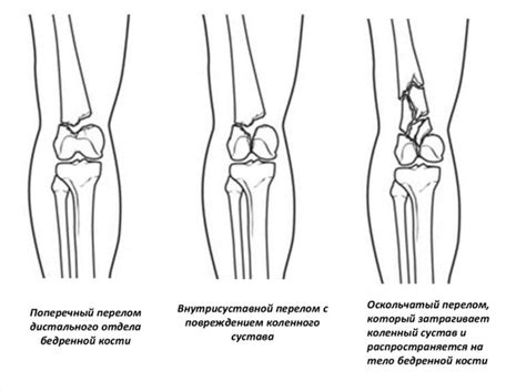 Перелом колена и его значение для здоровья