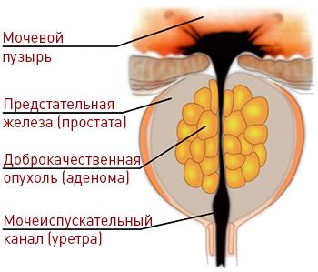 Периневральный рост опухоли предстательной железы