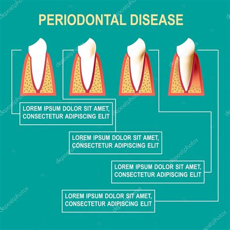 Периодонтальная болезнь: