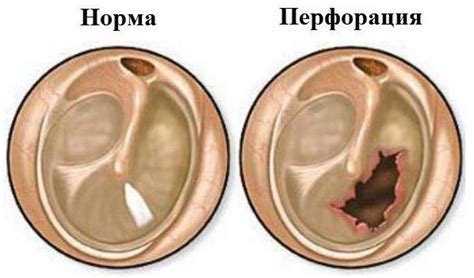 Перфорация барабанной перепонки