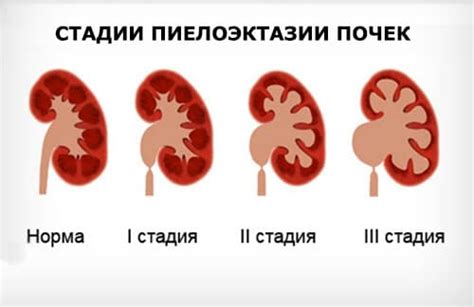 Пиелоэктазия почек у новорожденного: