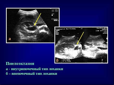 Пиелоэктазия правой почки