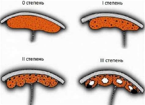 Плацента вверх: причины и последствия