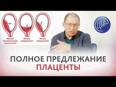 Плацента достигает внутреннего зева: значимость и воздействие