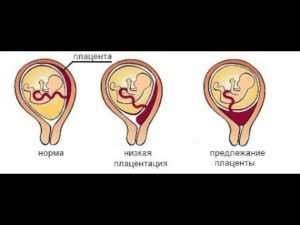 Плацента и ее положение по задней стенке выше внутреннего зева
