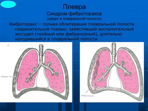 Плевроапикальные спайки: причина болезни и симптомы