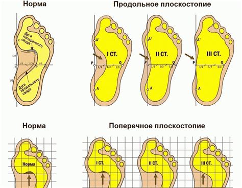 Плоскостопие и немой палец: связь и пути лечения