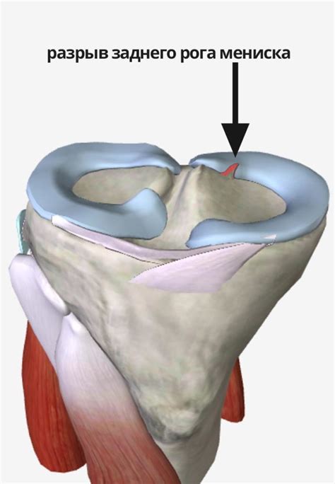 Повреждение заднего рога внутреннего мениска: причины, симптомы, лечение