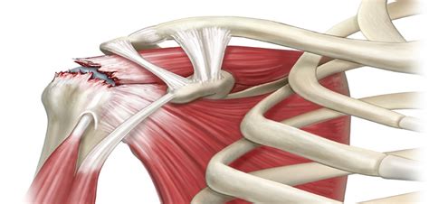 Повреждения надостной мышцы