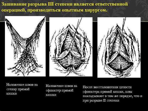 Повышенная вероятность разрыва матки