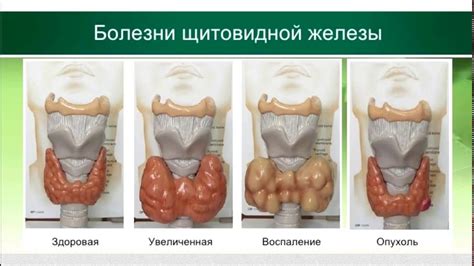 Повышенные иммуноглобулины и заболевания щитовидной железы