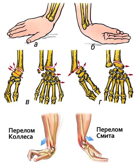 Подвернул руку - что это означает и как определить серьезность повреждения?