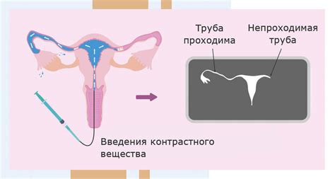 Подготовка и проведение ГСГ (Гистероскопии): шаги и техника