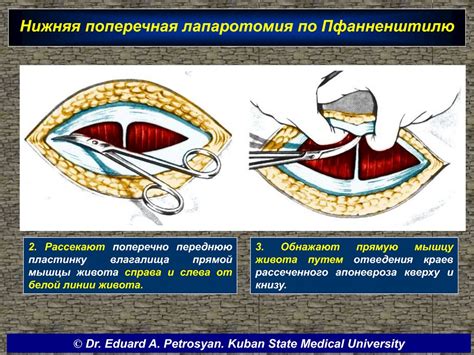 Подготовка к лапаротомии по Джоэлу Коэну