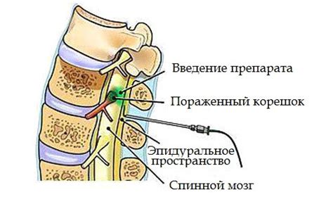 Показания для назначения блокады при остеохондрозе