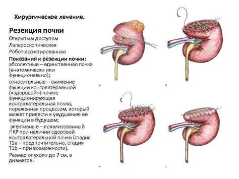 Показания для резекции почки