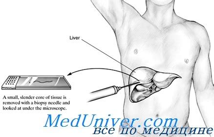 Показания и противопоказания для проведения биопсии печени