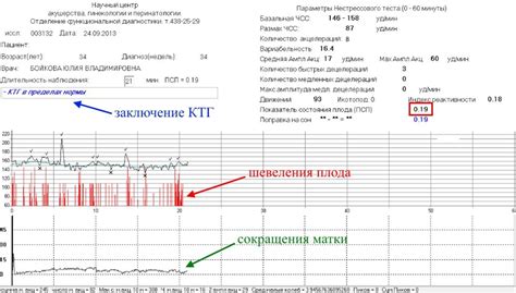 Показатели КТГ акцелерации